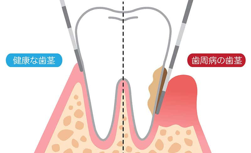 歯周病治療