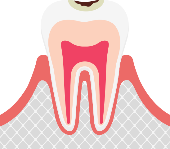 C1エナメル質の虫歯