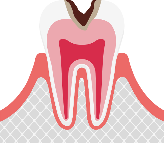 C2象牙質の虫歯
