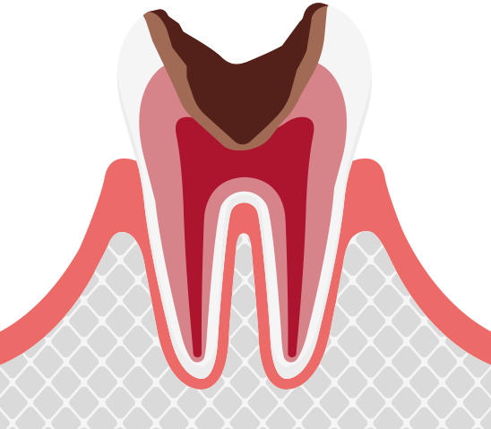 C3神経に達した虫歯