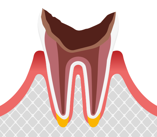 C4歯根に達した虫歯