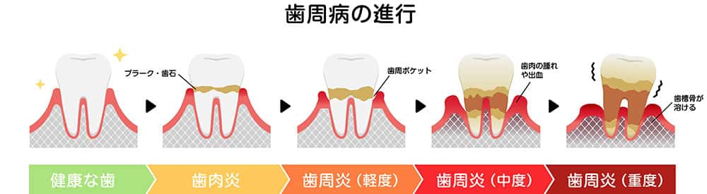 歯周病で歯を失わないために