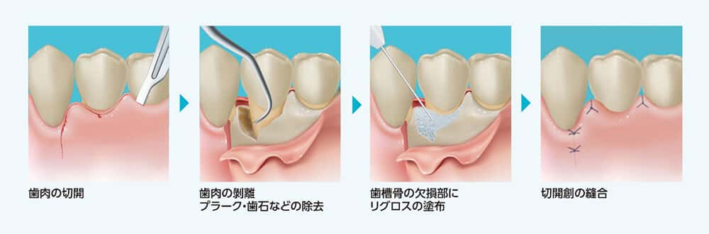 ～歯周組織の再生剤「リグロス」を取り扱っています～